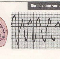fibrillazione ventricolare